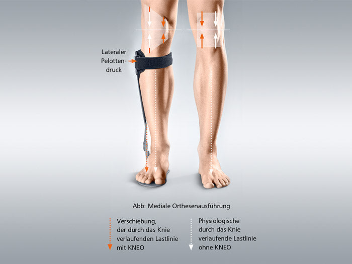 Ankle brace for the treatment of gonarthrosis by compartmental unloading Kneo