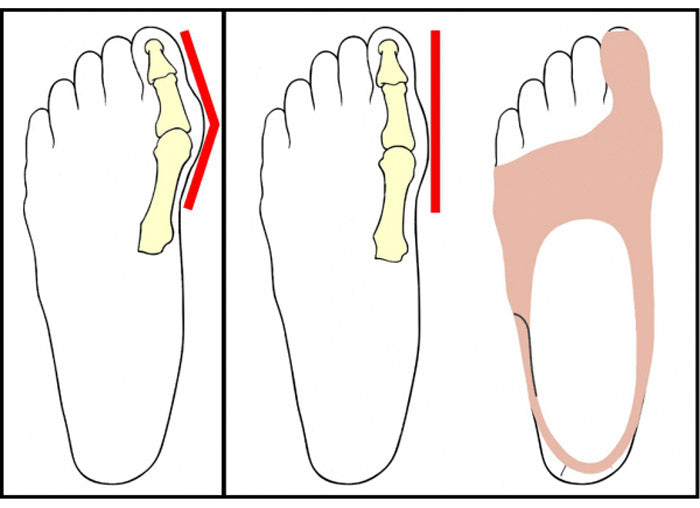 Gourallux Hallux-Valgus Corrector for the day