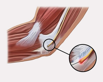 Attelle d'immobilisation du coude ElbowCurv OS