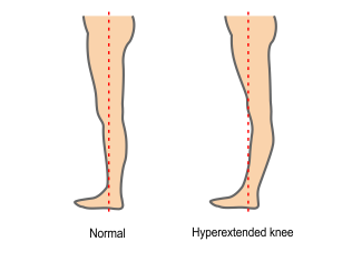 hyperextended knee brace NEURA-10