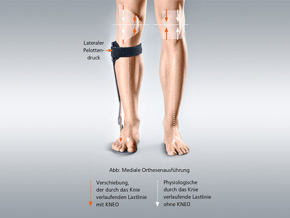 Ankle brace for the treatment of gonarthrosis by compartmental unloading Kneo
