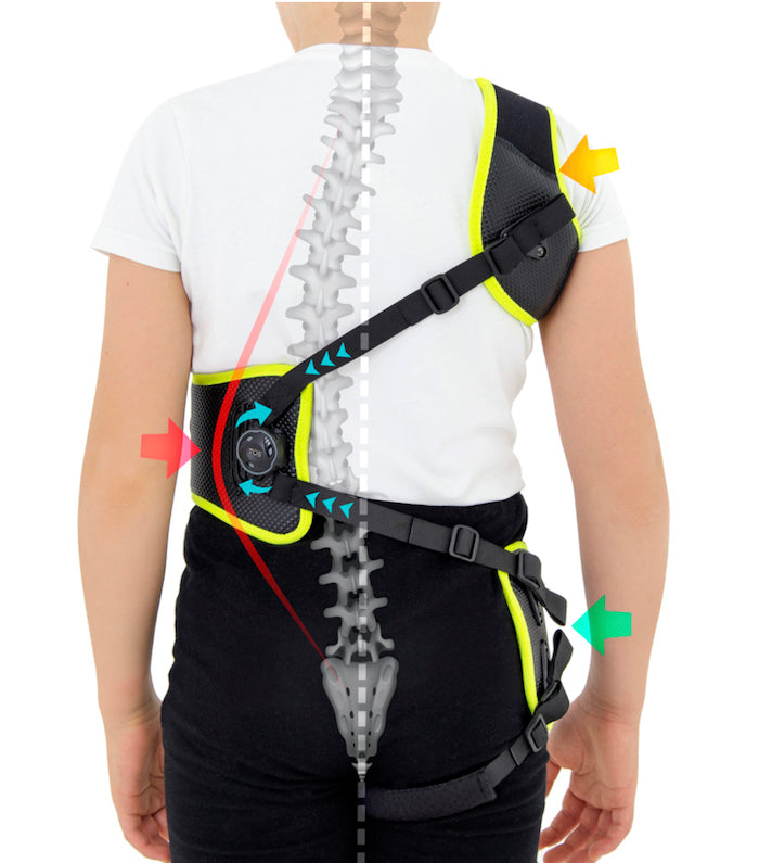 Active correction corset for scoliosis in children