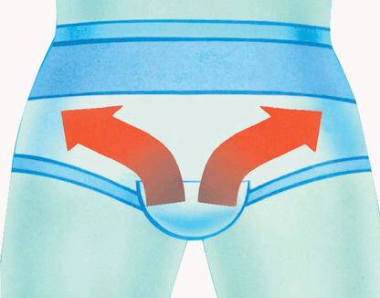 Slip herniaire post-opératoire ErniaSlip post-op 1